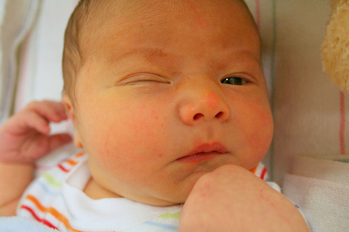 Cuidado de los ojos del recién nacido