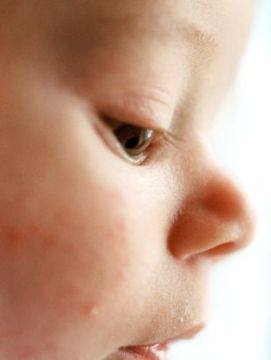 El acné infantil no es gran cosa ¡Entérate por qué!