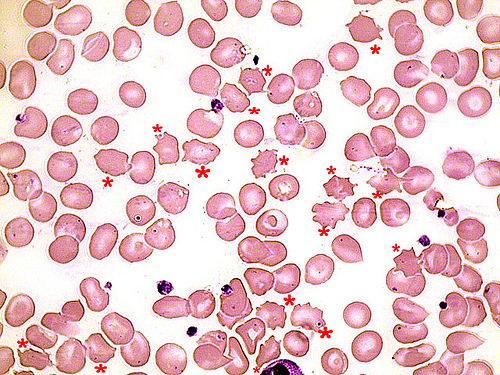 Exceso de glóbulos rojos en la sangre