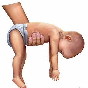 Hipotonía en recién nacidos