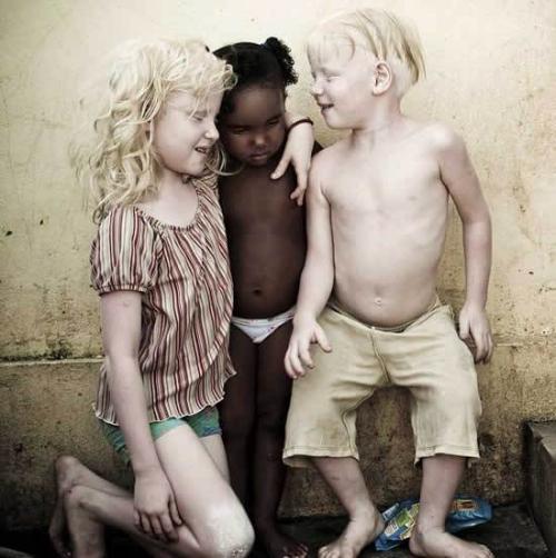 Niños albinos
